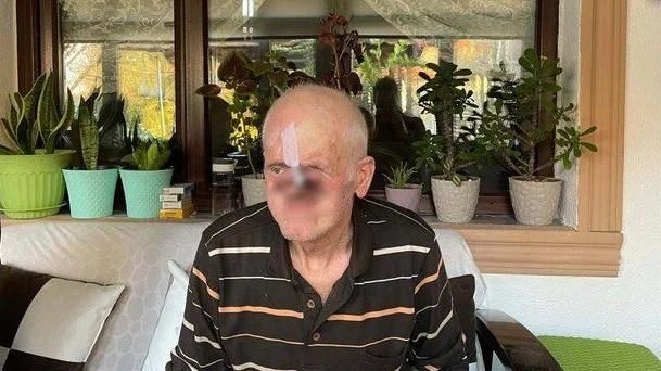 Her Şey Bir Sivilce ile Başladı!
