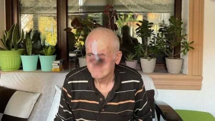 Her Şey Bir Sivilce ile Başladı!